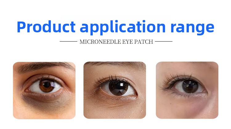 Double guide eye membrane soluble hyaluronic acid microneedles